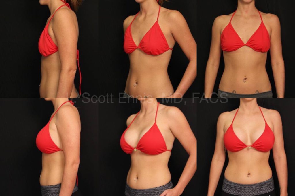 Breast Augmentation without Visible Scars in Boca
