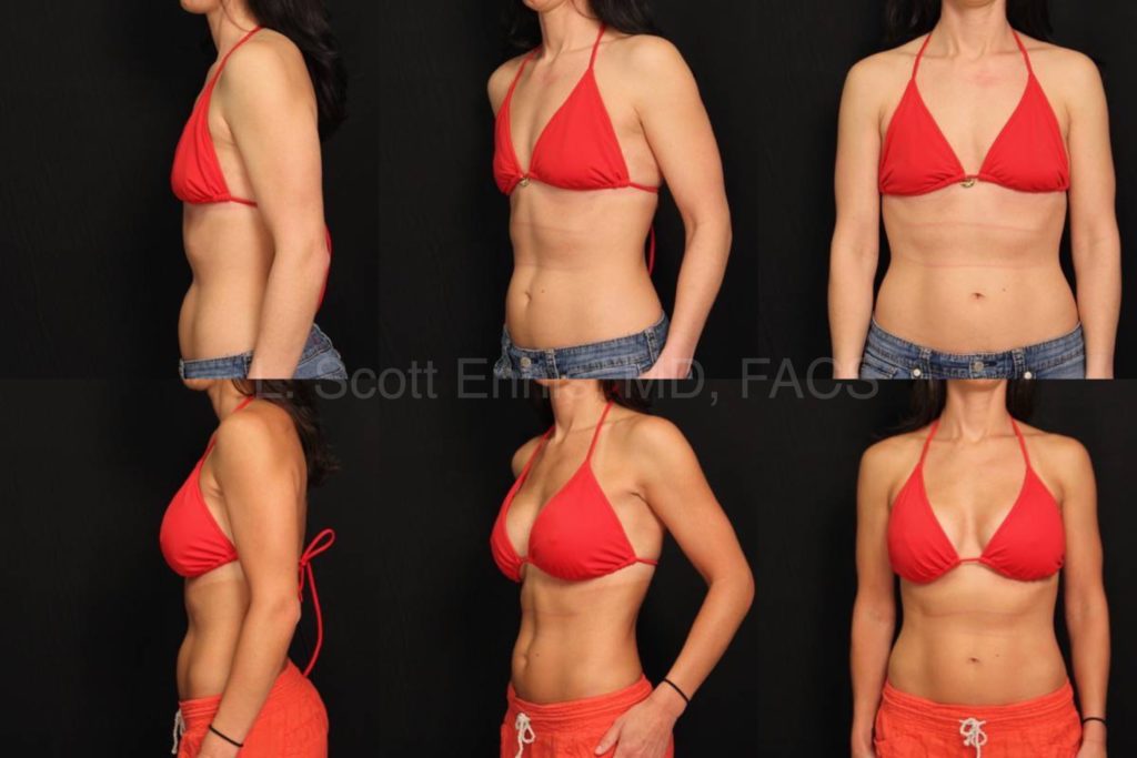Saline Gel Breast Implants vs Silicone Breast Implants, Which is