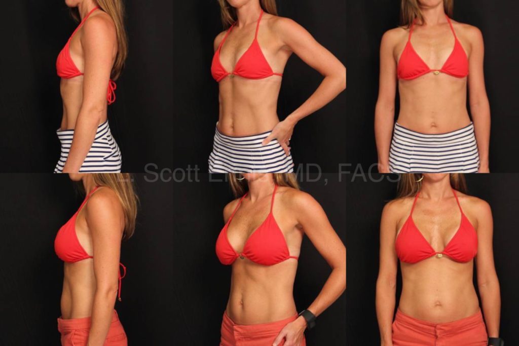 Breast Augmentation without Visible Scars in Boca