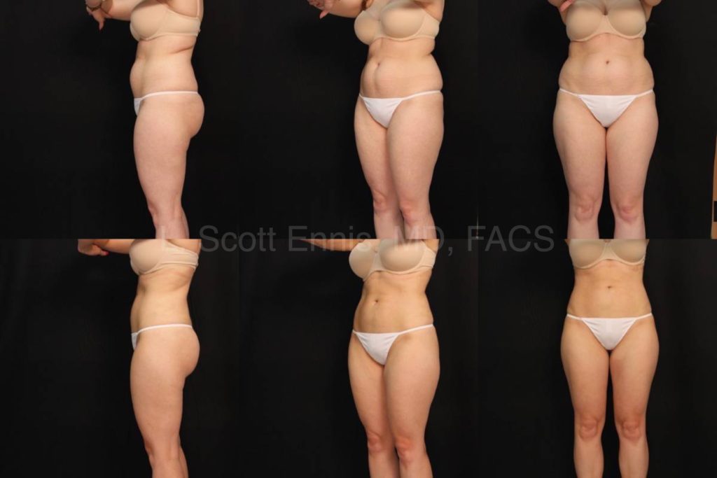 How Can I Improve My Body Contours With Liposuction?