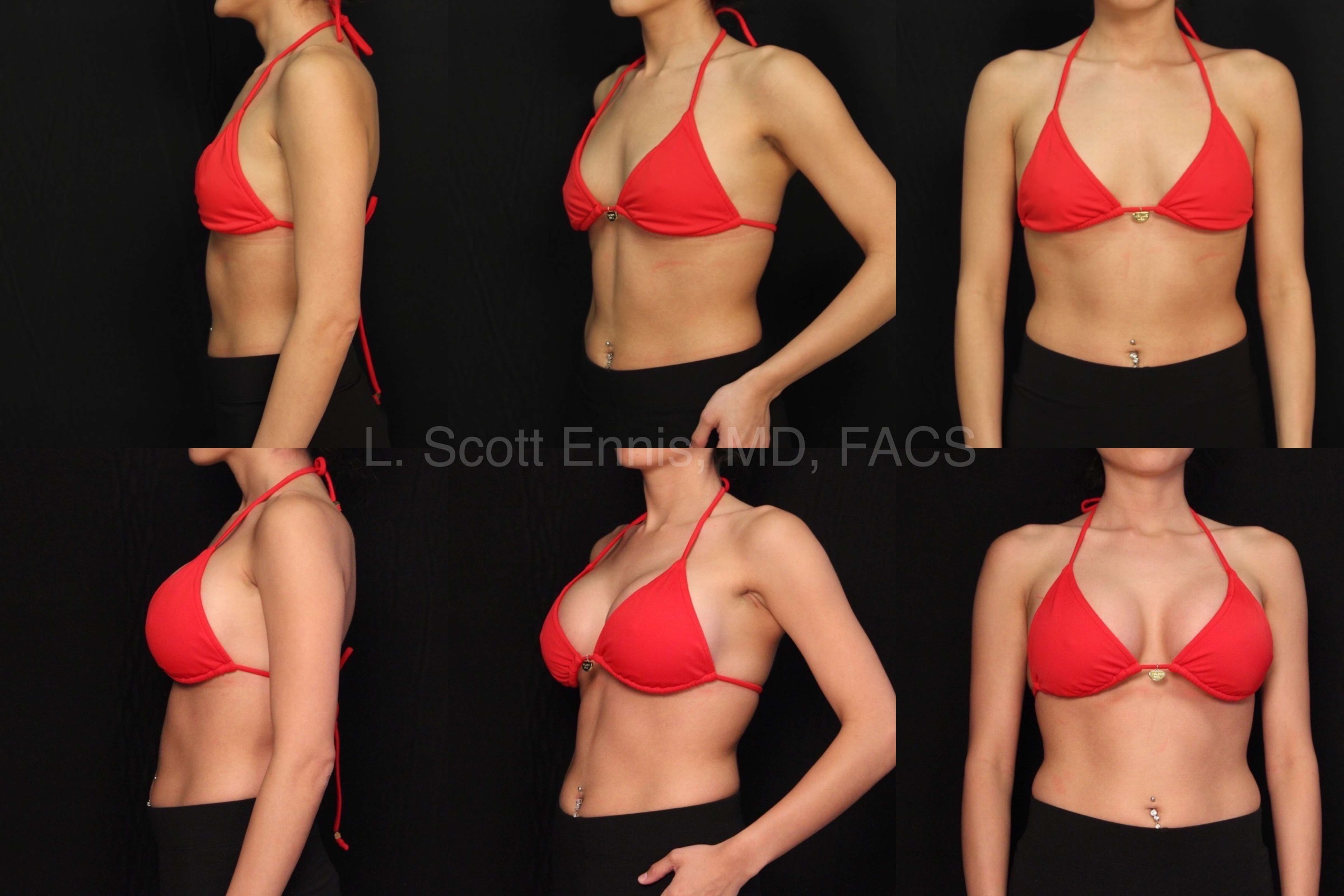 Breast Augmentation Size Chart