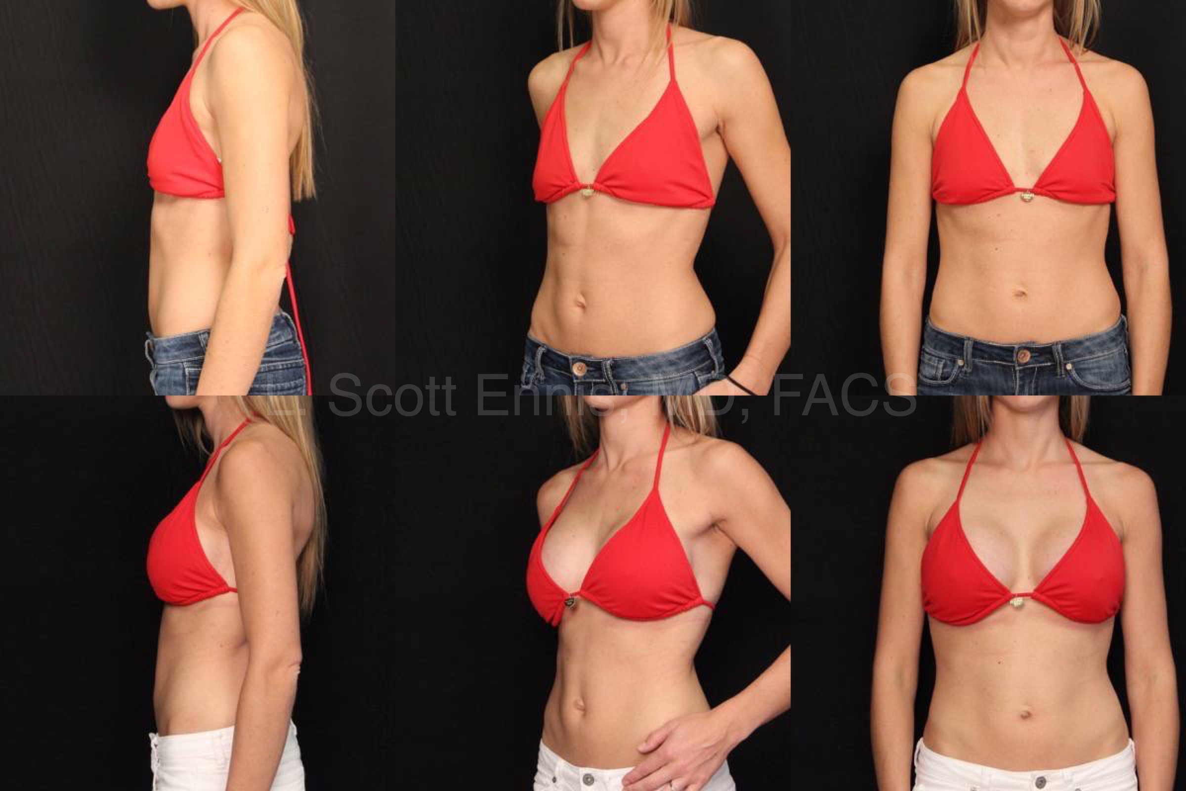 What is the Best Age for Breast Augmentation, How Old for Breast