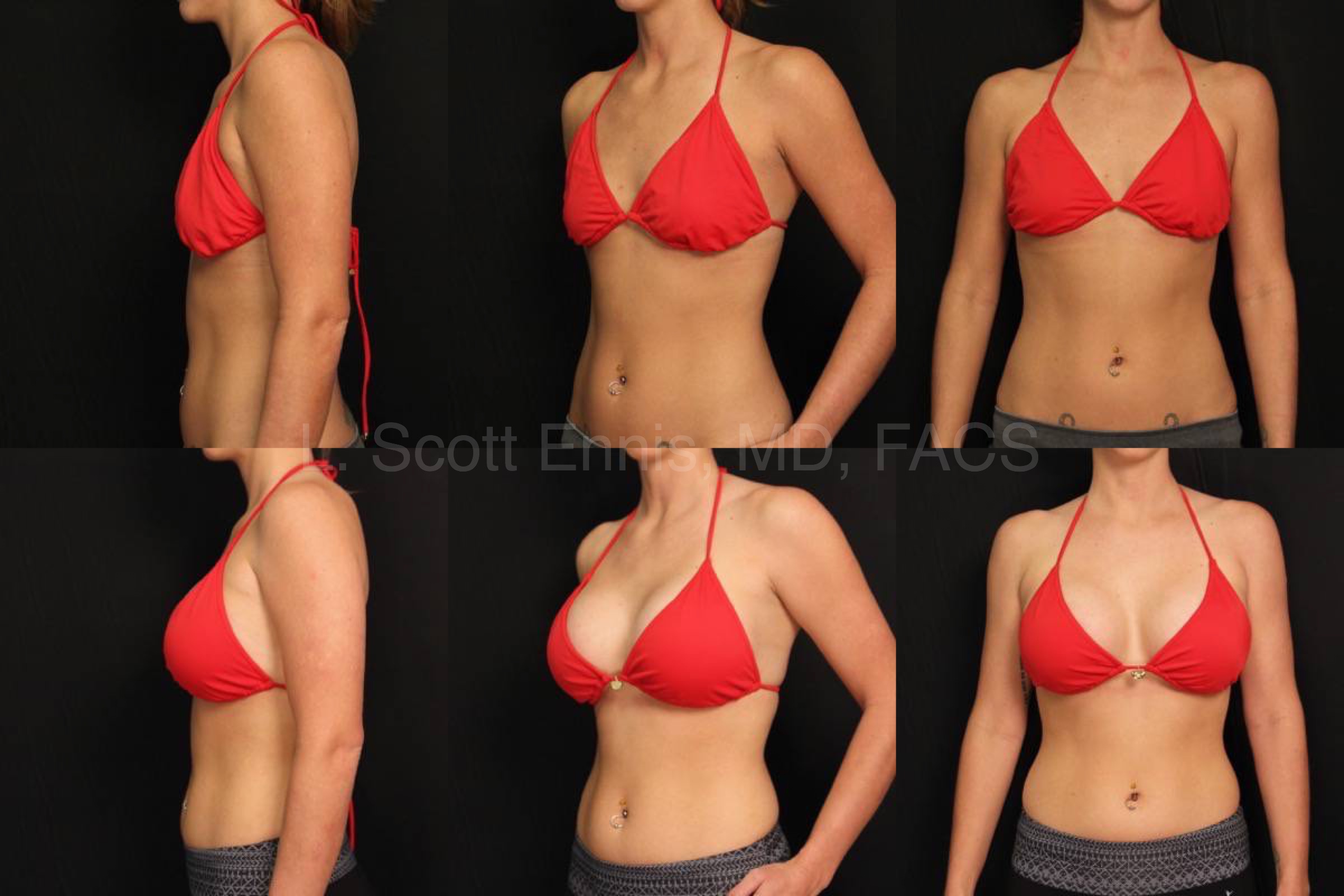Breast Augmentation Endo Sientra HP Gel R595  L545 29 5 10  145 A To D Before And After Ennis Plastic Surgery Palm Beach Boca Raton Destin Miami 37388 Covered 