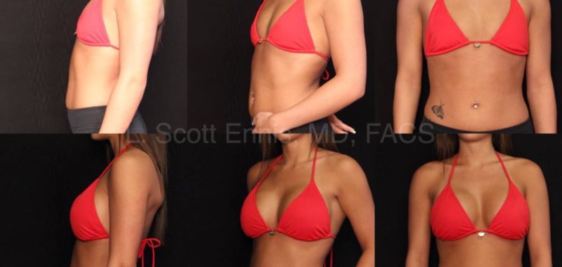 Breast Augmentation In Boca With No Scar On The Breast Dr L Scott Ennis