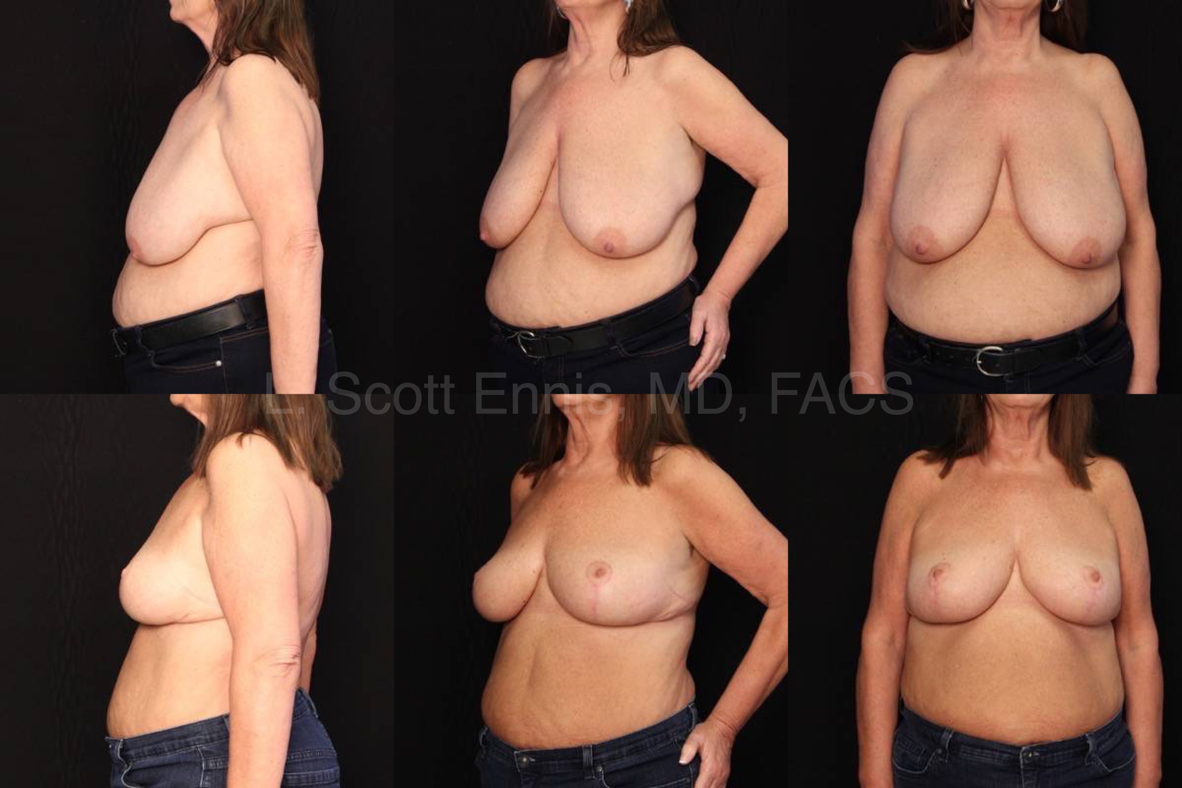 38ddd breasts