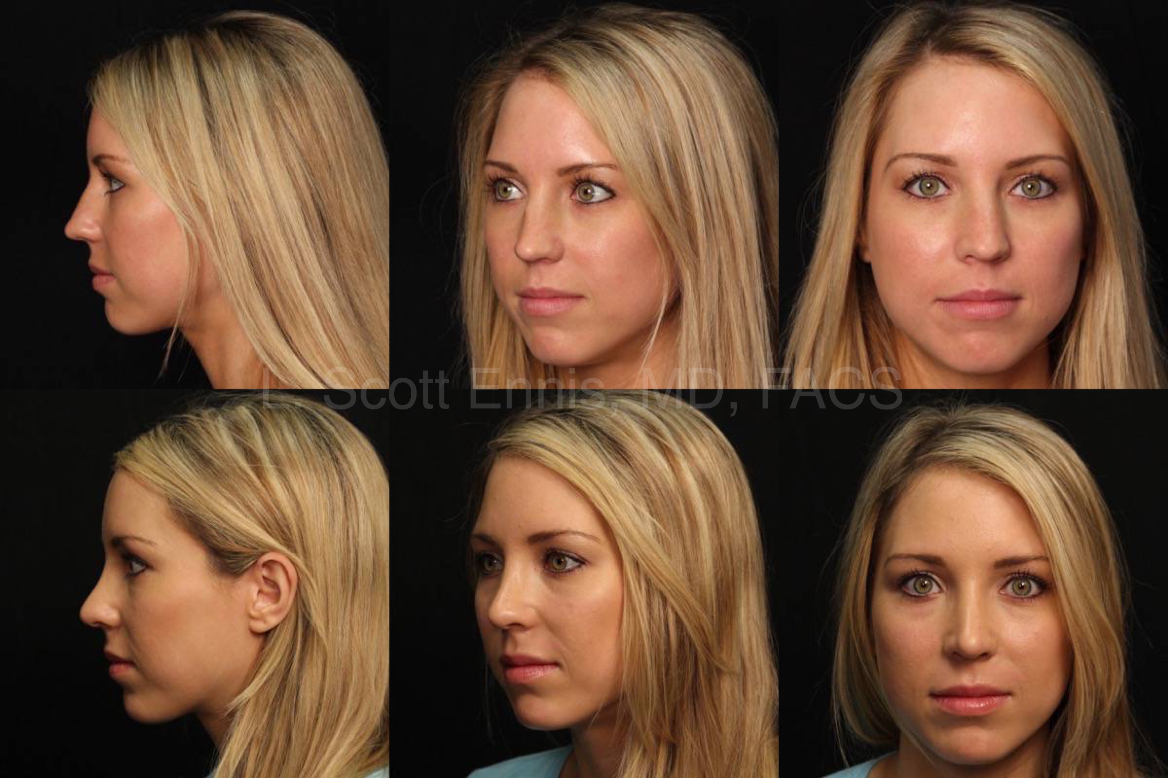 What Is the Best Age for Getting Rhinoplasty? Boulder CO - Boulder Plastic  Surgery