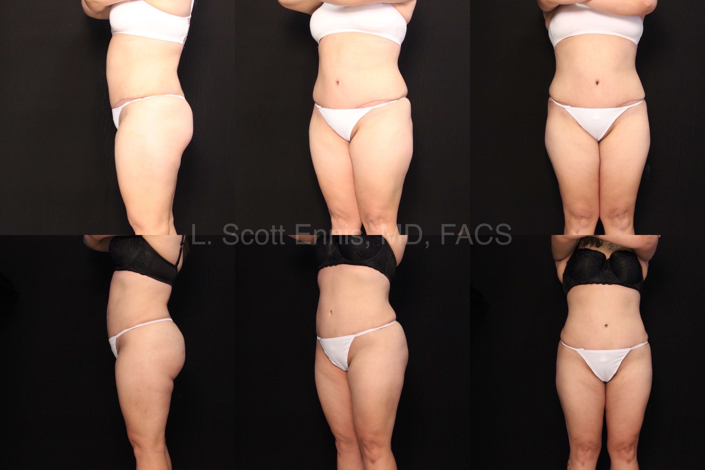 Drainless Tummy Tuck for Faster Recovery with Dr. Ennis