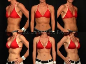 Ennis Plastic Surgery Offers Breast Augmentation With No Scar on