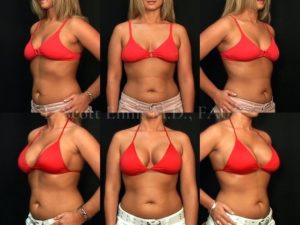 Breast Implant Exchange, Mastopexy & Internal Bra Before and After