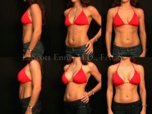 Before and After Ennis Plastic Surgery Palm Beach Boca Raton Destin Miami Fort Lauderdale Florida