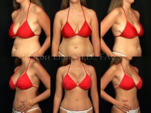 Breast Problems - Before and after
