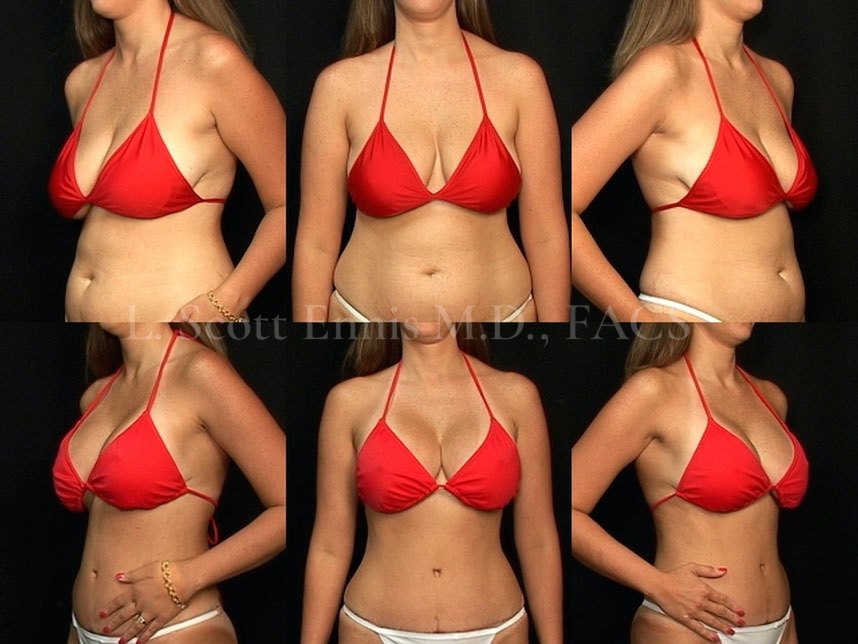 Athletic Breast Augmentation Gallery Before & After 01