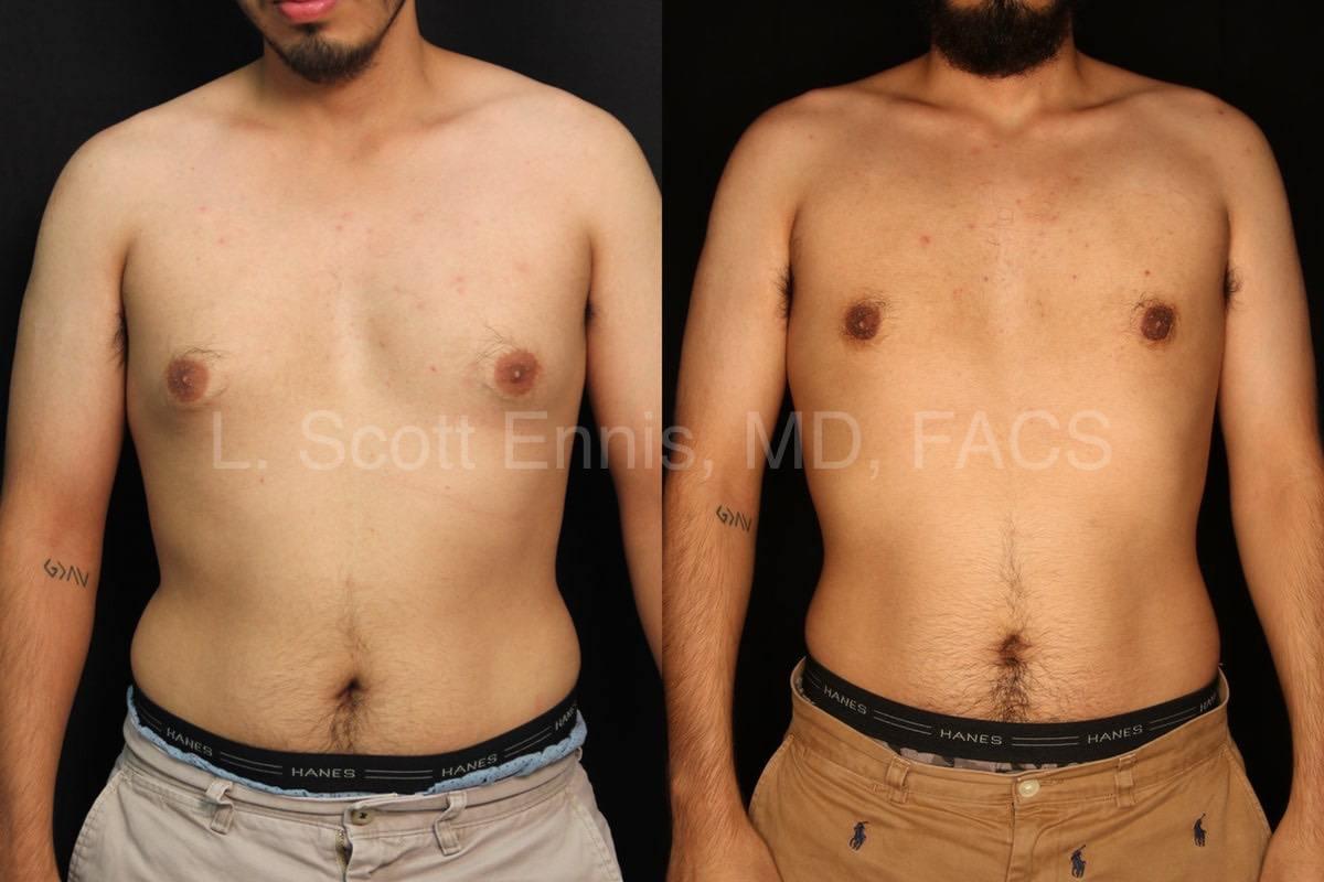 Liposucción para Hombres Antes y Despues - Ennis Plastic Surgery