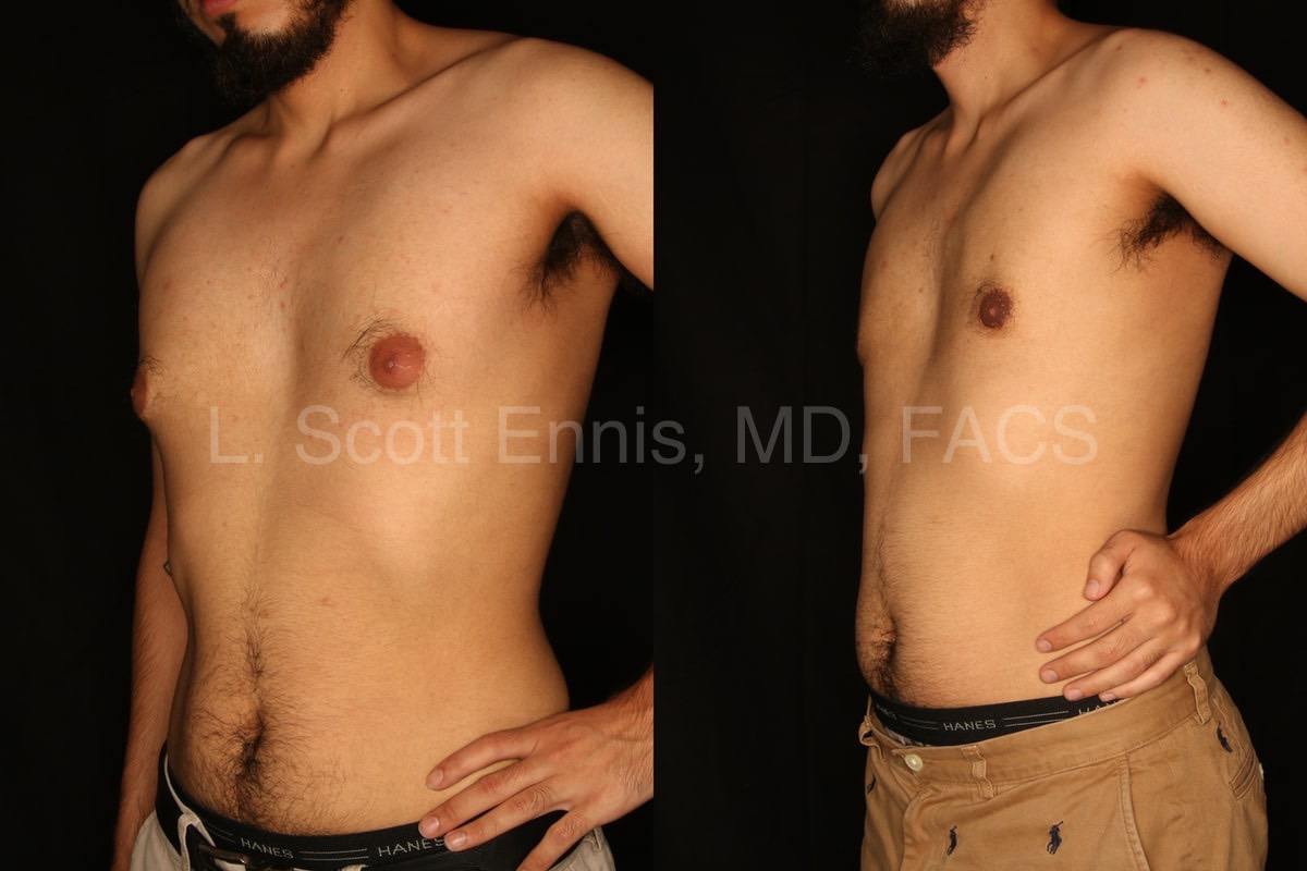 Liposucción para Hombres Antes y Despues - Ennis Plastic Surgery