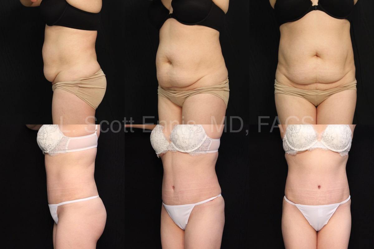 Ten of the Best Tummy Tuck Recovery Tips