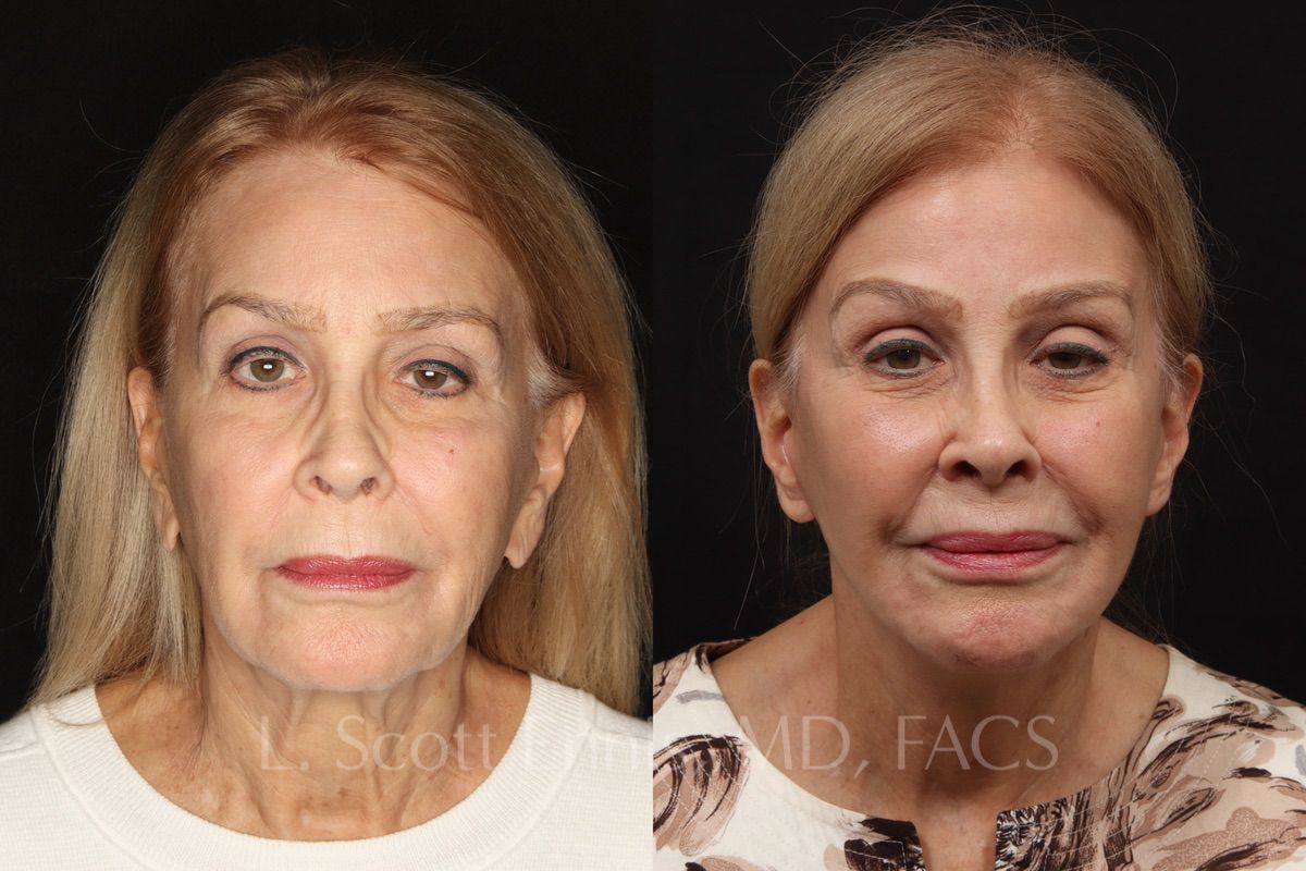 Facelift Before & After Photos by Ennis Plastic Surgery in Boca Raton