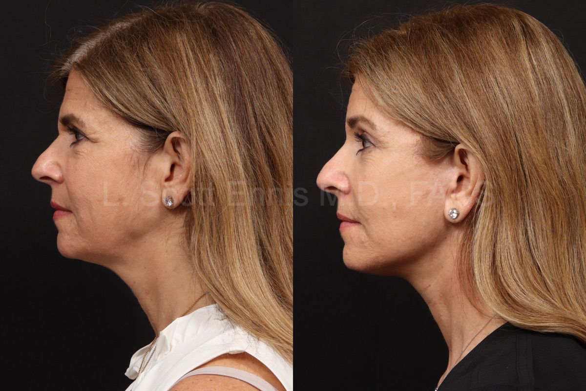 Facelift with Buccal Fat Pad Removal and Profound RF on the Neck - Carolina  Facial Plastics