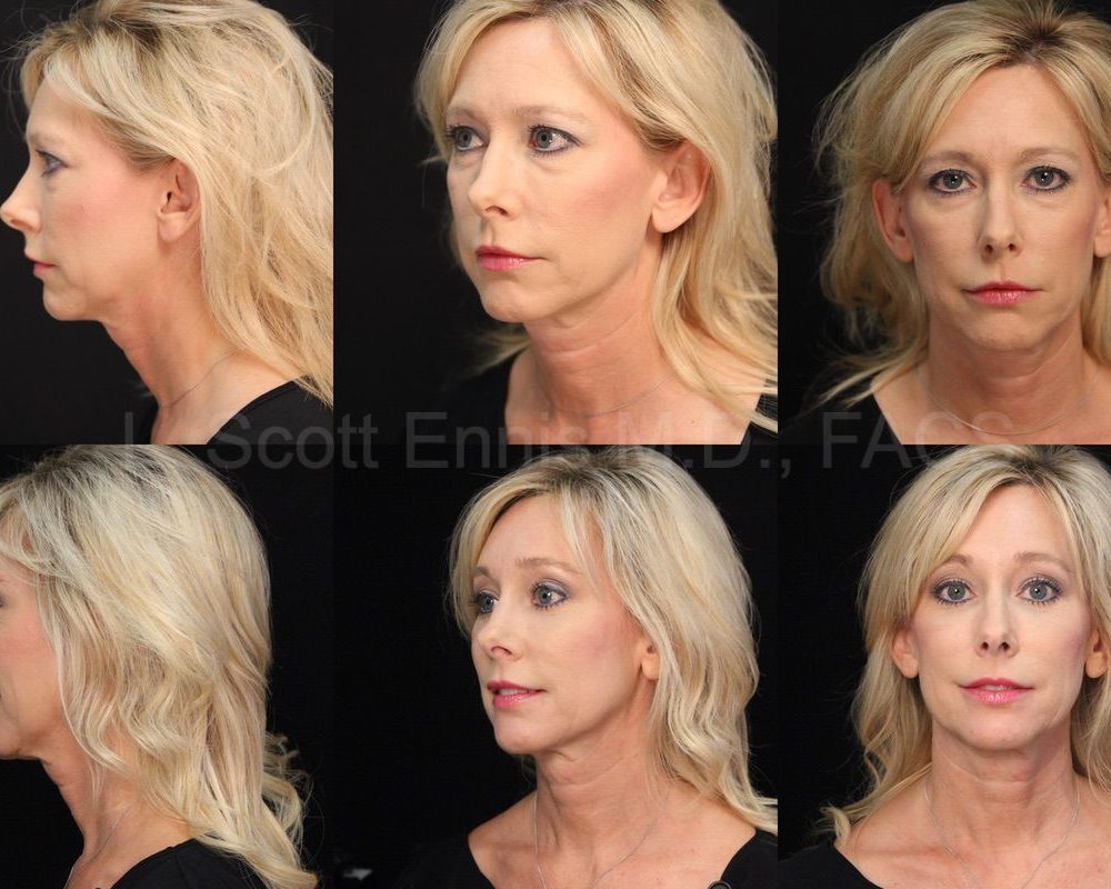 Brow List vs Upper Blepharoplasty