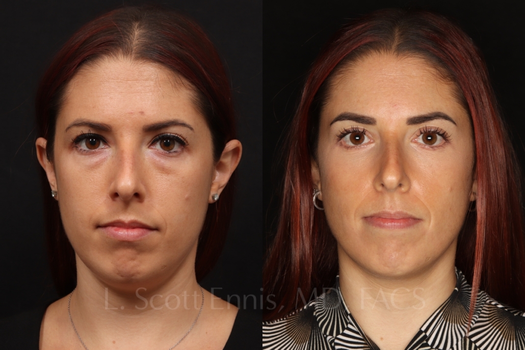 lower blepharoplasty 34 female before and after photos