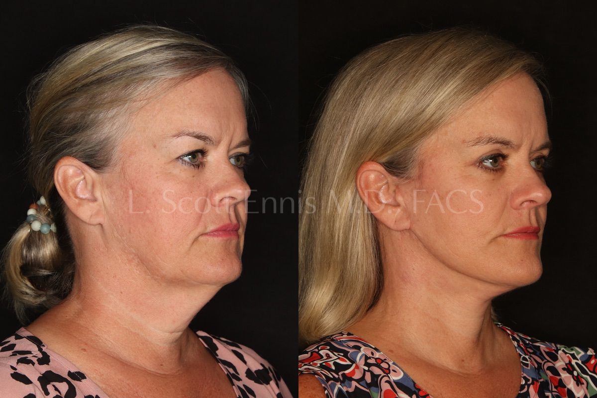 buccal fat removal 10 years later