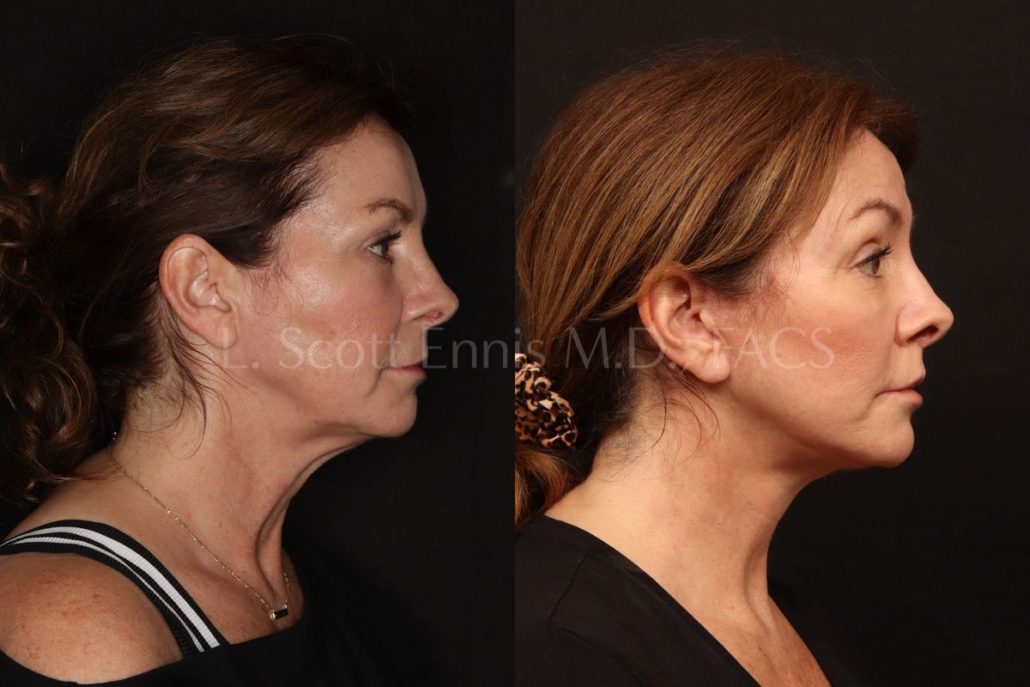 Deep Plane Facelift / Lower Blepharoplasty / Upper Lip Lift/ Buccal Fat Pad Removal/ Obagi Blue Peel