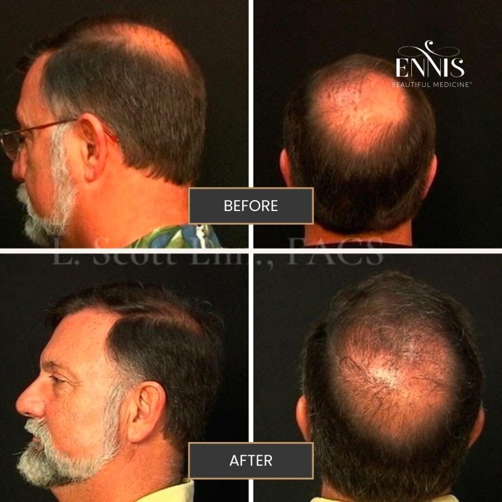 Hair Transplant Boca Raton Before and After by Dr Ennis IG 4