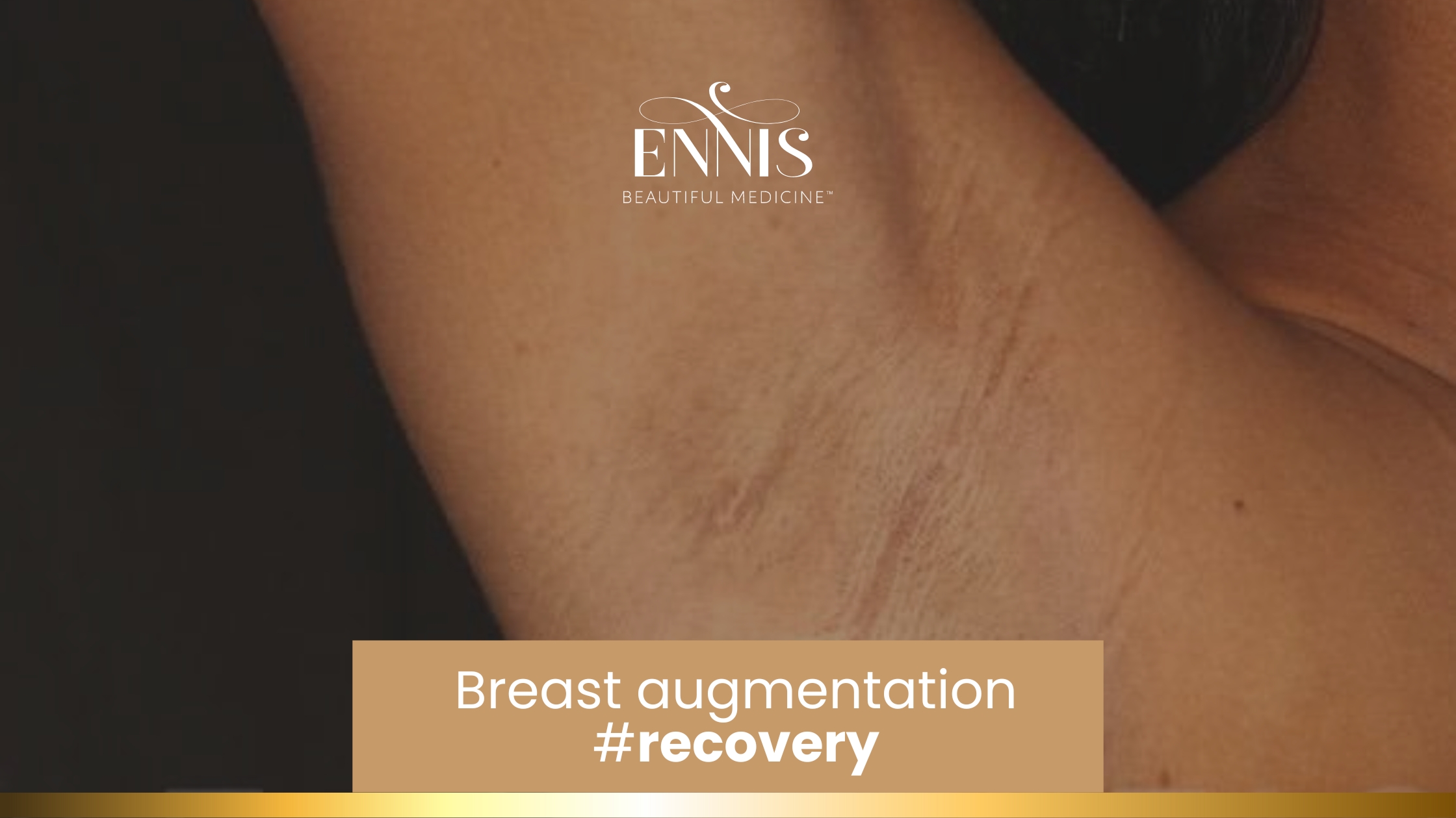 Top 7 Tips to Ease Your Breast Augmentation Recovery