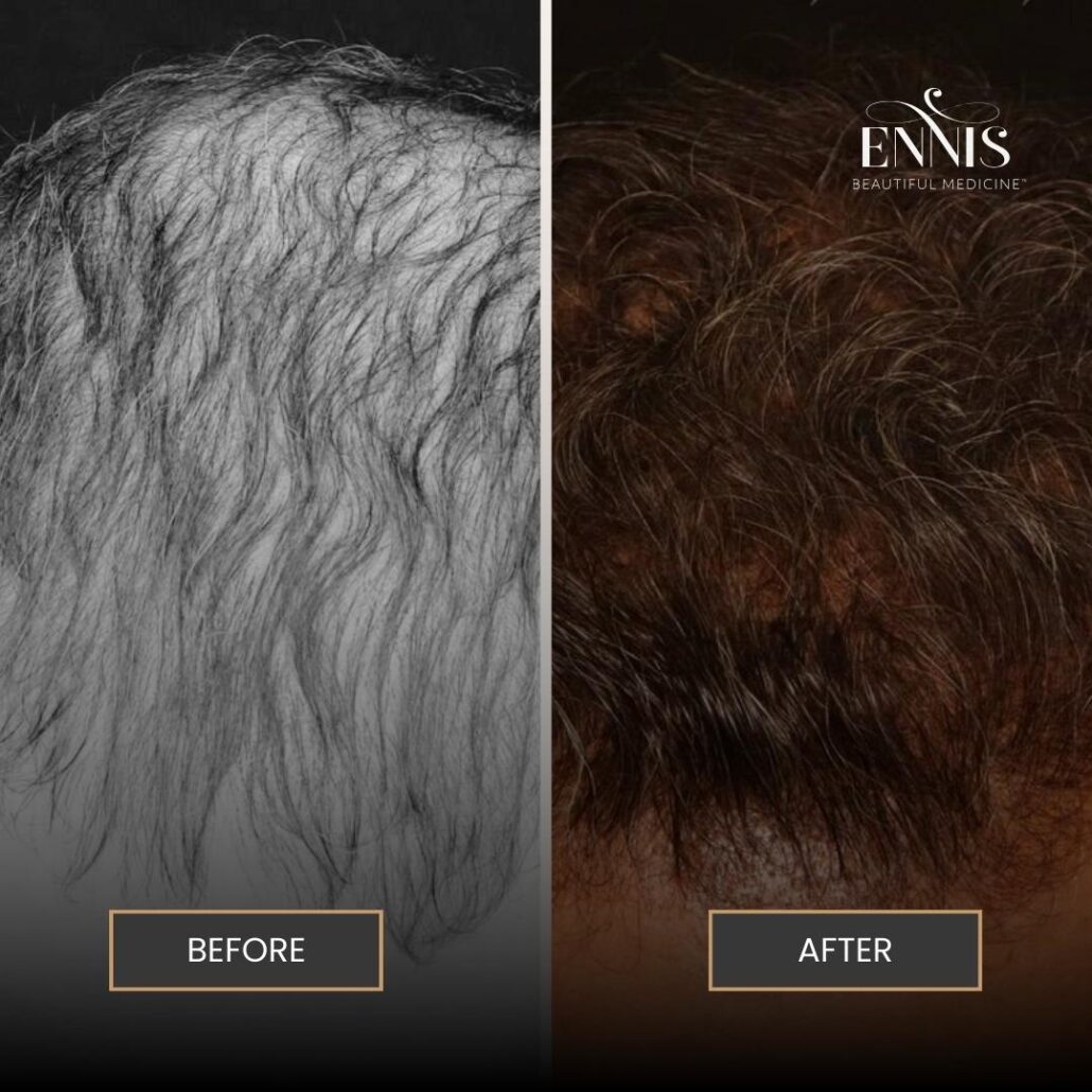 Hair Transplant Boca Raton Before and After by Dr Ennis IG 1