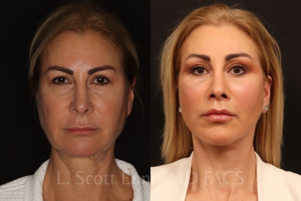 Endoscopic Brow lift Lower blepharoplasty deep plane facelift upper lip lift buffalo fat pad removal Ennis Plastic Surgery Before After Miami Boca Raton Palm Beach Fort Lauderdale Florida