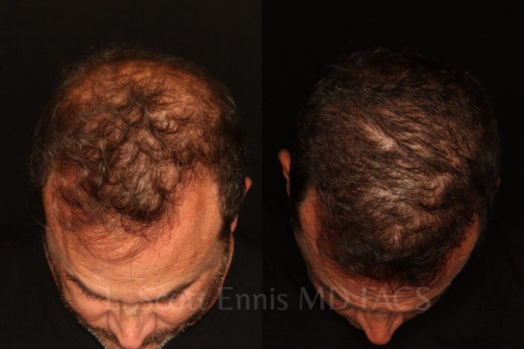 Hair Transplant Restoration before and after by Dr. Scott Ennis at Ennis Plastic Surgery in Boca Raton Fort Lauderdale Miami